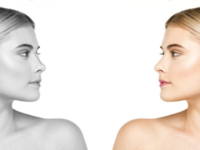 side-view-woman-before-after-rhinoplasty